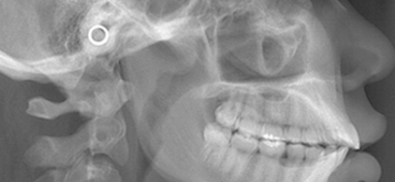 Telerradiografia Lateral 